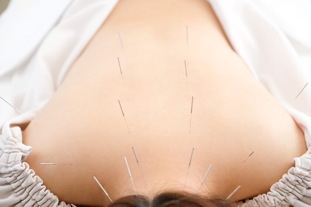 Anatomical Acupuncture Edmonton