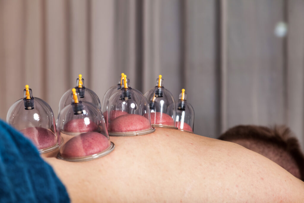 Cupping Therapy