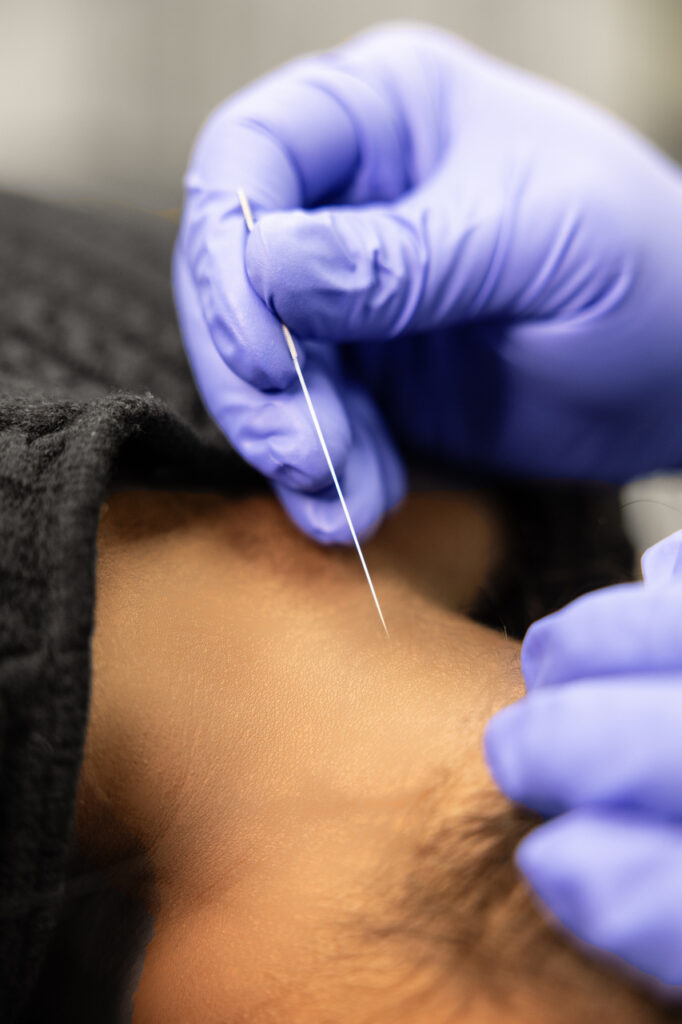 Find Anatomical Acupuncture For Pain Relief And Return Of Function